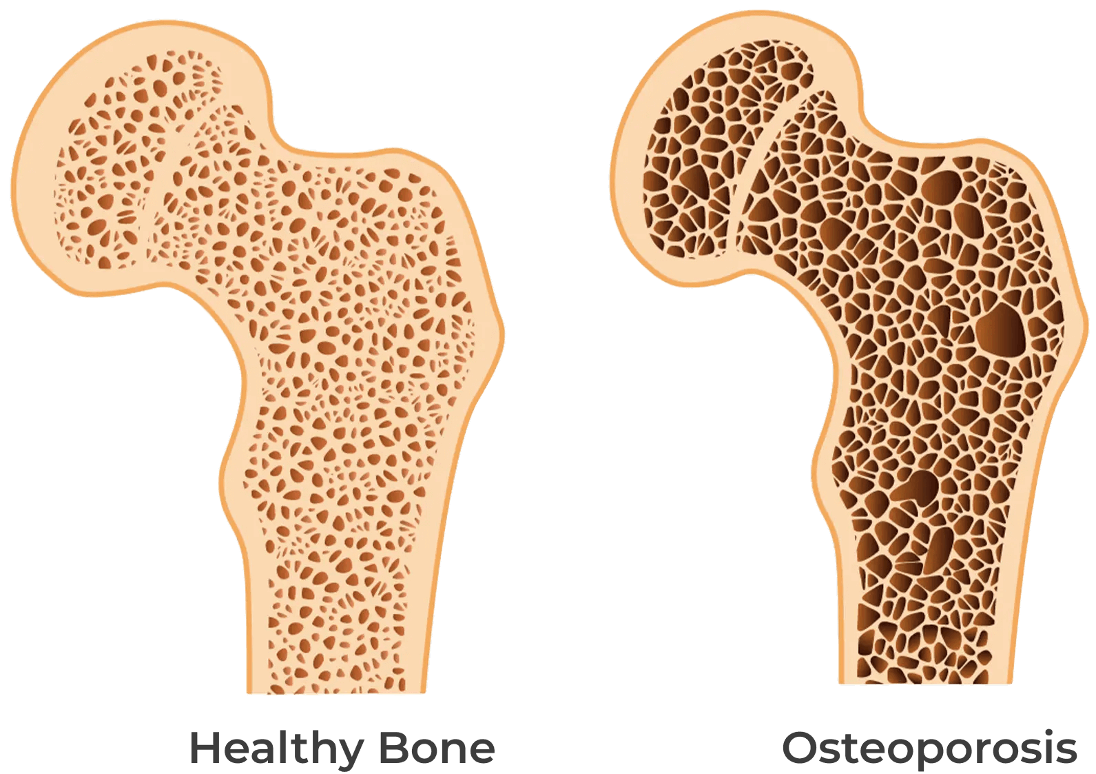 normal_bone_vs_osteoporosis (1)